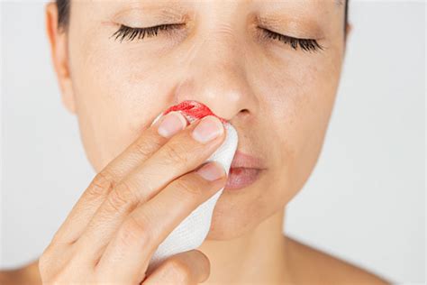 What You Need To Know About Nosebleeds In Pregnancy