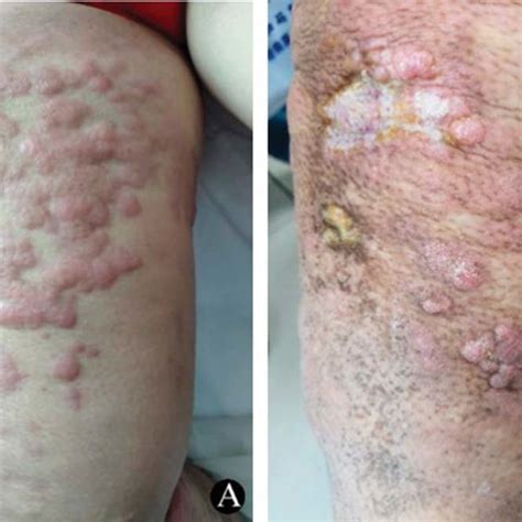 Pdf A Case Of Cd5 Positive Primary Cutaneous Diffuse Large B Cell