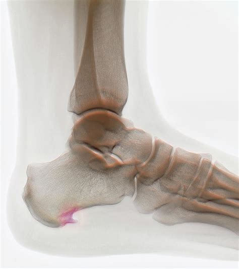 Muscles Of The Foot Posterior View Photograph By Qa International Fine