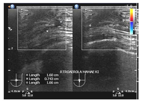 Ultrasound Examination Of Gynecomastia Case In Male Patient Case Report