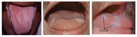 Hiv Tongue See Pictures Identify Symptoms At Every Hiv Stage Std Testing Near Me