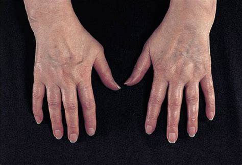 Arthritis Bumps On Knuckles