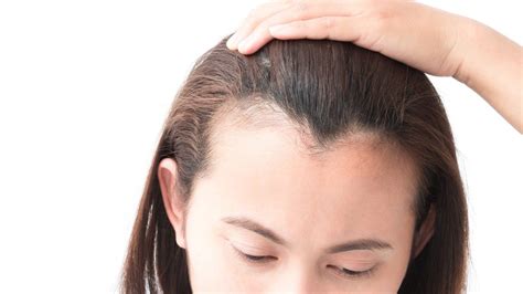 Woman Pulling Back Her Hair To Show Her Hairline Thinning Hairline Hairstyles For Receding