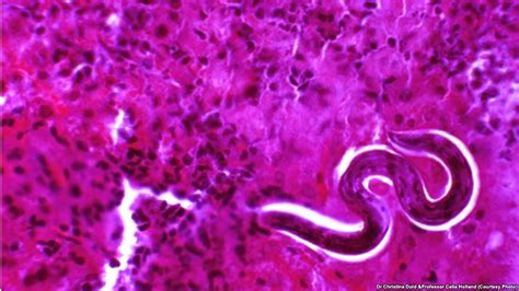 Researchers Exploring Ways To Fight Roundworm Infection Voa Learning