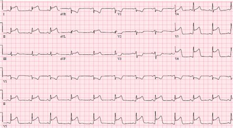 Image 2 Ekg Obtained After The Initial Ekg Showing St Segment
