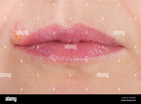 Herpes On The Lip Close Up Macro Stock Photo Alamy