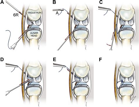 Arthroscopic Management Of Triangular Fibrocartilage Complex Peripheral