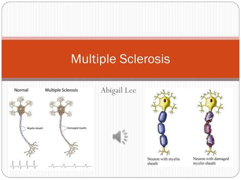 Ppt Multiple Sclerosis Powerpoint Presentation Free Download Id