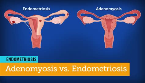 Adenomyosis Vs Endometriosis Are They One And The Same