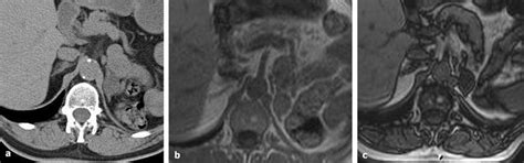 Left Adrenal Cortisol Secreting Adenoma A Unenhanced Ct Scan Shows A