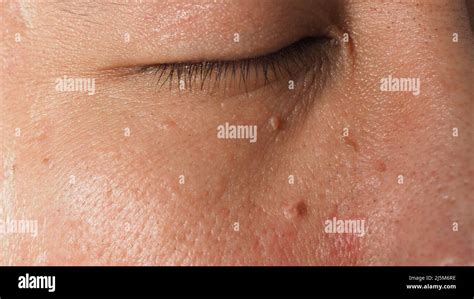Wart Skin Removal Macro Shot Of Warts Near Eye On Face Papilloma On