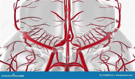 An Aneurysm Is The Ballooning Expansion Of A Blood Vessel Due To
