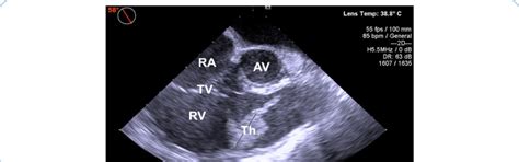 Transesophageal Echocardiography Image With A Floating Thrombus In The