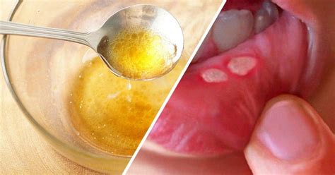 10 Ways To Quickly Heal A Painful Mouth Ulcer Using Coconut Oil Honey