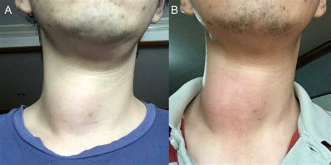 Epidermoid Cyst Abscess Of The Neck Masquerading As A Thyroid Abscess