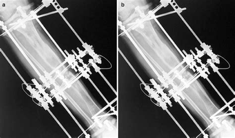 Ap A And Lat B Radiographs 8 Months After Operation Bone Grafting