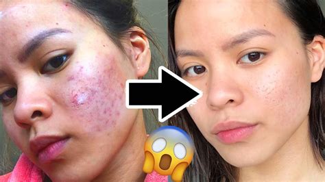 How To Clear Acne Scars Fast At Home Grizzbye