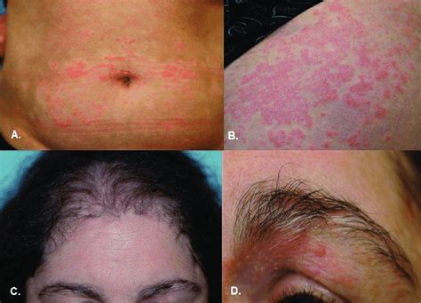 Psoriasis Restricted To The Vitiliginous Area On A The Abdomen And