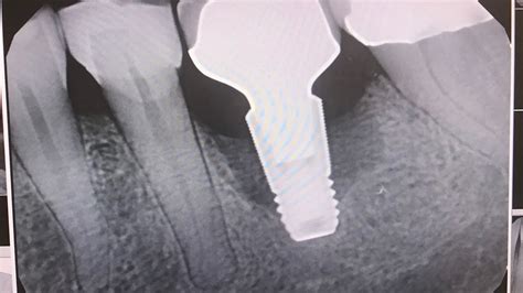 How To Identify A Failing Implant A Dental Hygienists Perspective