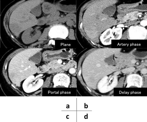 An Abdominal Contrast Enhanced Computed Tomography Ct Scan Showed A