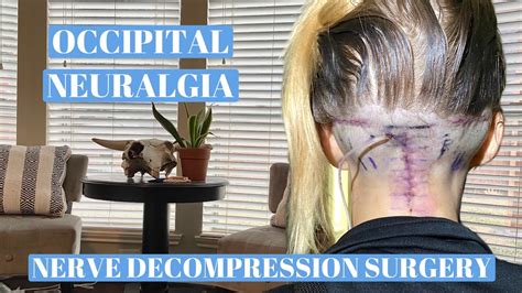 Occipital Neuralgia Surgery Video Mapayakusa