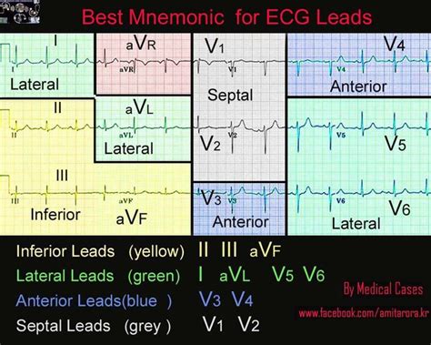 12 Lead Ecg Nursing Mnemonics Emergency Nursing Ecg Nursing