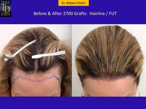 Hairline Fut Female Before And After Hair Transplant Sexiezpicz Web Porn