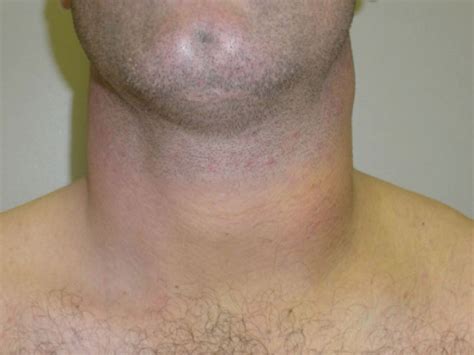 Traumatic Rupture Of Sternocleidomastoid Muscle Following An Epileptic