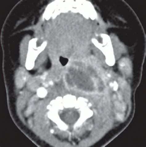 Retropharyngeal Abscess Radiology Key