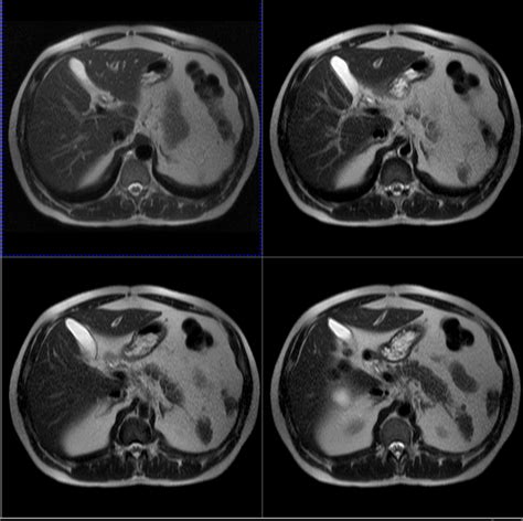 Mri Abdomen And Pelvis