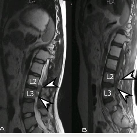 MRI Whole Spine Sagittal View A T Weighted And B T Weighted Download Scientific Diagram
