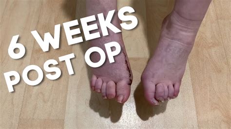 6 Weeks After Bunion Surgery Youtube