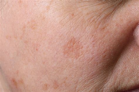 The Difference Between Sunspot Skin And Age Spots Plus Removal Options