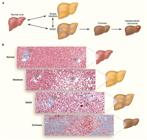 Human Fatty Liver Disease Old Questions And New Insights Science