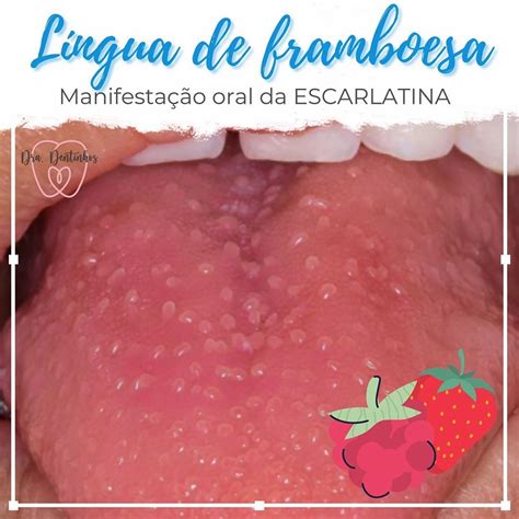 Escarlatina Lingua Em Framboesa