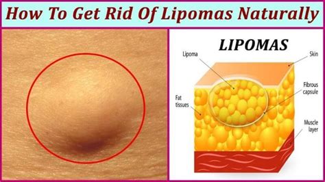 Infections often lead to swollen lymph nodes in the neck or other areas of the body. How To Naturally Cure And Prevent Lipoma Lumps Review ...