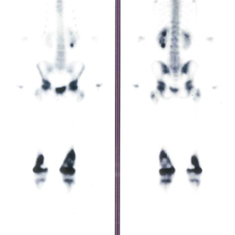 Bone Scintigraphy With A High Degree Of Osteoblastic Activity In