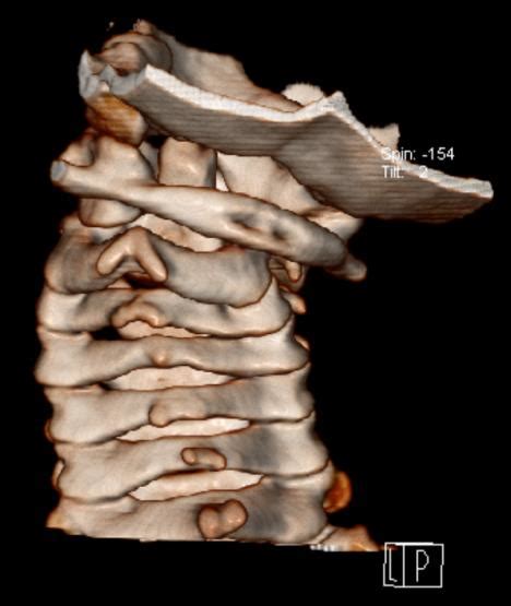 3d Reconstruction Ct Scan Confirming Rotatory Atlantoaxial Subluxation