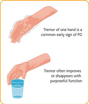 Essential tremor is an action tremor, meaning that the involuntary shaking increases when you move and try to use your hands. Tremor - Terapi Sehat : Info Kesehatan Medis dan Alternatif