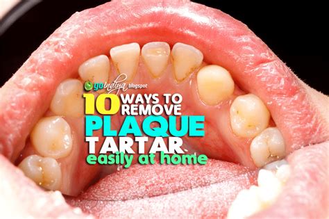 10 easy ways to remove plaque and tartar from teeth at home naturally natural home remedies