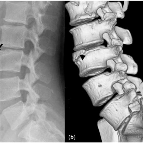 The Radiography Of The Lumbar Spine A Revealed A Large Bony Fragment
