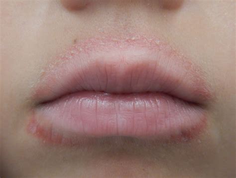 Perioral Dermatitis And Causes Of A Red Ring Around The Lips