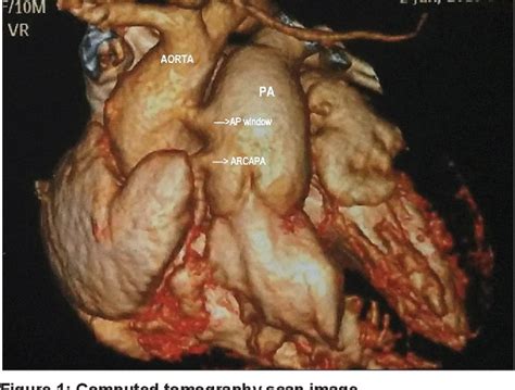 Figure 1 From Anomalous Origin Of The Right Coronary Artery From The