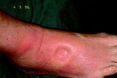 Remitting Distal Lower Extremity Swelling With Pitting Oedema In Acute