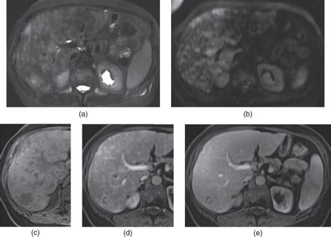 Liver Metastases Radiology Key