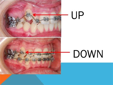 How Does Orthodontics Work Youtube