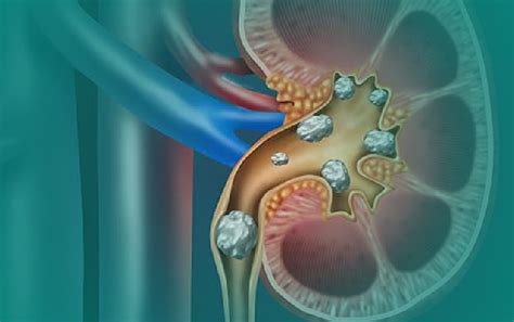 Kidney Stones And Bladder Infections