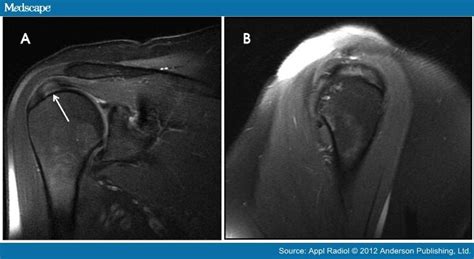 Rotator Cuff Mri Anatomy