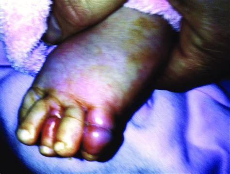 Photo Of Left Foot Showing Erythema And Edema Distal To Hair Toe
