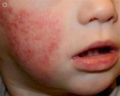 Dermatitis Atópica En Niños Top Doctors